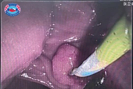 Cứu bệnh nhân u lớn đầu tụy làm biến dạng tá tràng