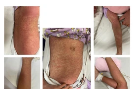 Bé gái 10 tuổi nổi ban toàn thân, không ngờ mắc bệnh hiếm