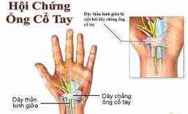 Cách chữa đau, tê, cứng cổ tay