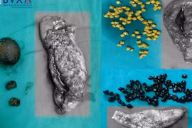 10% dân số mắc sỏi túi mật: Phòng ngừa cách nào