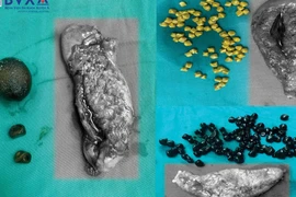 10% dân số mắc sỏi túi mật: Phòng ngừa cách nào