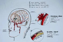 Bác sĩ chỉ rõ những rủi ro xảy ra đột quỵ ở người trẻ