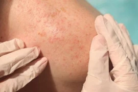 Cách phòng tránh các bệnh về da thường gặp khi nắng nóng