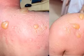 2 ca bỏng loét, hoại tử nặng vì tự ý điều trị tại nhà