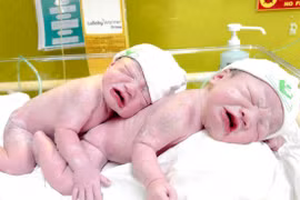 Cặp song sinh siêu nghịch: Một dây rốn thắt nút, một 3 vòng rau quấn cổ