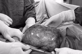 Mổ cứu bệnh nhân ung thư buồng trứng "khổng lồ" kèm nhồi máu phổi