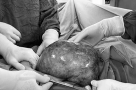 Mổ cứu bệnh nhân ung thư buồng trứng "khổng lồ" kèm nhồi máu phổi