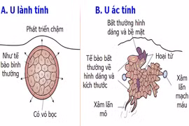Khối u lành tính và khối u ác tính khác nhau như thế nào?