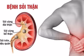 Những thói quen thường ngày là “hung thủ” gây sỏi thận