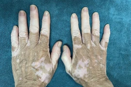 Một trường hợp mắc bệnh bạch biến đến khám tại Bệnh viện