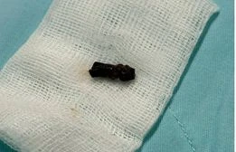 Bé trai 8 tháng suýt tử vong do hóc cuống trái xoài