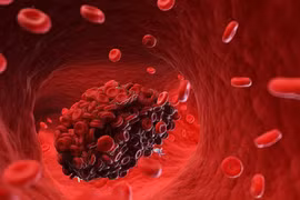 Cách phát hiện và điều trị bệnh lý cục máu đông