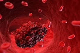 Cách phát hiện và điều trị bệnh lý cục máu đông
