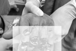 Người đàn ông nhập viện với bàn tay vẫn còn trong máy xay thịt