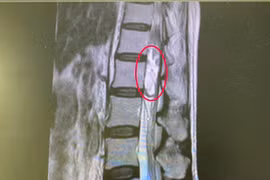 Cứu người phụ nữ thoát khỏi nguy cơ liệt hai chân do u tủy sống