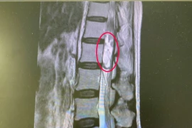 Cứu người phụ nữ thoát khỏi nguy cơ liệt hai chân do u tủy sống