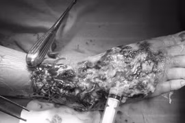 Nhiễm khuẩn huyết, hoại tử chân vì...cho ong đốt để chữa viêm khớp