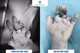 Dùng máy cưa sắt, thanh niên 39 tuổi phải vi phẫu trồng lại các ngón tay 