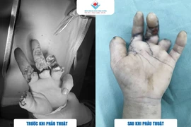 Dùng máy cưa sắt, thanh niên 39 tuổi phải vi phẫu trồng lại các ngón tay 