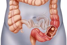 Bác sĩ chỉ rõ đối tượng bị polyp đại tràng dễ biến thành ung thư