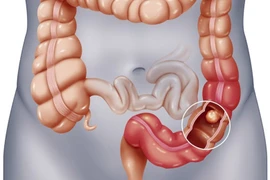 Bác sĩ chỉ rõ đối tượng bị polyp đại tràng dễ biến thành ung thư