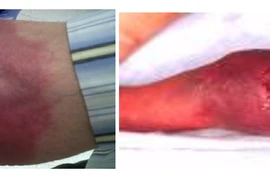 Cách gì phòng ngừa và chăm sóc da hoại tử do thoát mạch hóa chất?