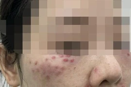  Nhiều người gặp tai biến vì làm đẹp bằng tế bào gốc