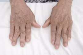 Bác sĩ chỉ rõ các triệu chứng thường thấy của bệnh viêm khớp dạng thấp