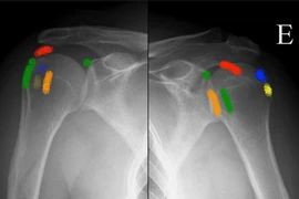 Bác sĩ chỉ cách chữa đau vai nhiều về đêm do viêm gân vôi hóa