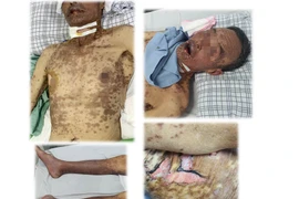 Loét toàn bộ da và niêm mạc do dị ứng thuốc với chứng hiếm gặp Stevens-Johnson/Lyell