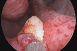 Thấy khó thở, đi kiểm tra tá hỏa phát hiện răng mọc trong mũi 