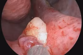 Thấy khó thở, đi kiểm tra tá hỏa phát hiện răng mọc trong mũi 