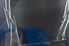 Giáo viên yoga bẻ gãy xương đùi của học viên trong lúc dạy 