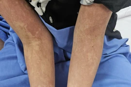 2 trẻ nhập viện gấp vì nhiễm xoắn khuẩn nguy hiểm