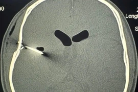 Người đàn ông bị đinh sắt đâm xuyên xương sọ