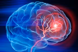 Người đàn ông liệt nửa người do chủ quan sau đột quỵ 