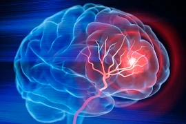 Người đàn ông liệt nửa người do chủ quan sau đột quỵ 