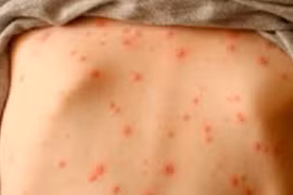 Một công ty ở Bến Tre có 83 ca mắc thủy đậu