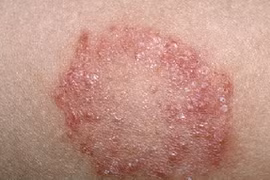 Điểm mặt bệnh ngoài da người Việt mắc nhiều nhất hè 2018