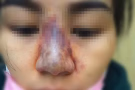 Liên tục cấp cứu biến chứng tiêm filler, bác sĩ nói gì?