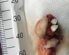 Phát hiện khối u quái dị mọc răng trong bụng bé gái 12 tuổi ở Quảng Ninh