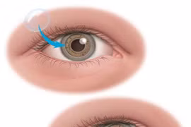 Từ "ngọn lửa Hải An, Vân Nhi": Những điều ít biết về cấy ghép giác mạc 