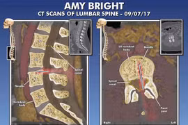 Bị liệt vì bác sĩ để quên kim tiêm trong cột sống suốt 14 năm 