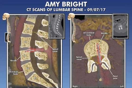 Bị liệt vì bác sĩ để quên kim tiêm trong cột sống suốt 14 năm 