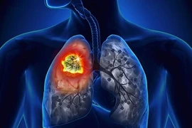 Những dấu hiệu sớm cảnh báo bệnh ung thư phổi