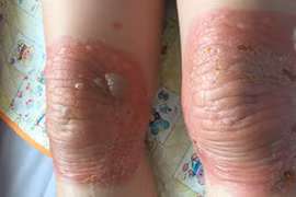 Bỏng nặng, thoái hóa khớp do bó thuốc nam chữa đau khớp gối 