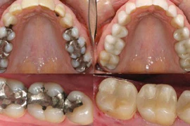 Video: Mẹo thần kì giúp răng sâu mọc trở lại