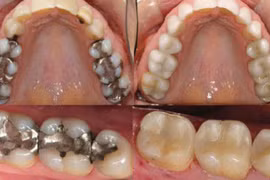 Video: Mẹo thần kì giúp răng sâu mọc trở lại