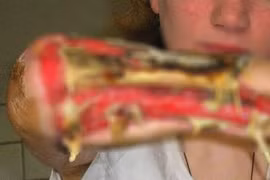 Hãi hùng loại ma tuý "ăn thịt người" từng mảng