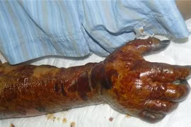 Hoại tử, tử vong do... sử dụng nước bẩn